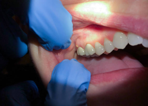 Best Emergency Dental Care for Abscessed Tooth in Shelburn, IN