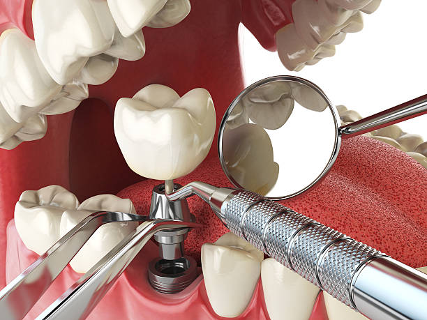 Best Emergency Dentist for Lost Fillings or Crowns in Shelburn, IN